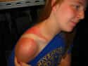 Gingers Burn The Hardest on Random Epic and Painful Sunburns