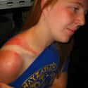 Gingers Burn The Hardest on Random Epic and Painful Sunburns