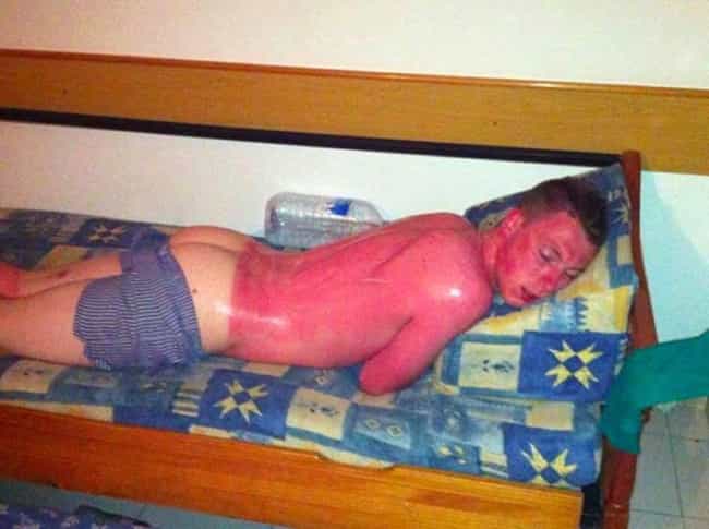 Bilderesultat for worst sunburned