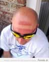This Man Who Will Wear Hats Like A Person Now on Random Epic and Painful Sunburns