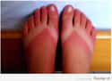 When You Forget Your Feet on Random Epic and Painful Sunburns