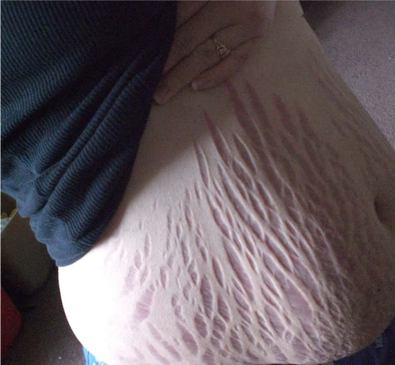 These Super Intense Stretch Marks