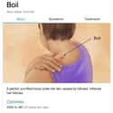 Boil: Maybe It's Just Backne on Random Weird Medical Drawings Google Thinks You Need