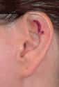 What Kind Of Earlobe Do You Have? on Random Most Bizarre Plastic Surgery Procedures