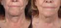 Remove Neck Wrinkles With This Easy Step on Random Most Bizarre Plastic Surgery Procedures