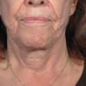 Remove Neck Wrinkles With This Easy Step on Random Most Bizarre Plastic Surgery Procedures