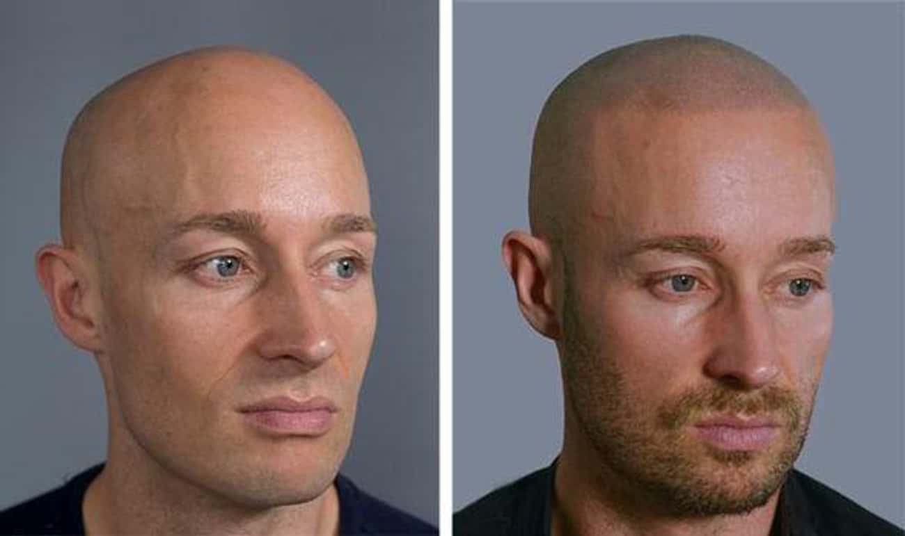 The Newest Hair Loss Fad: Hair That&#39;ll Never Recede