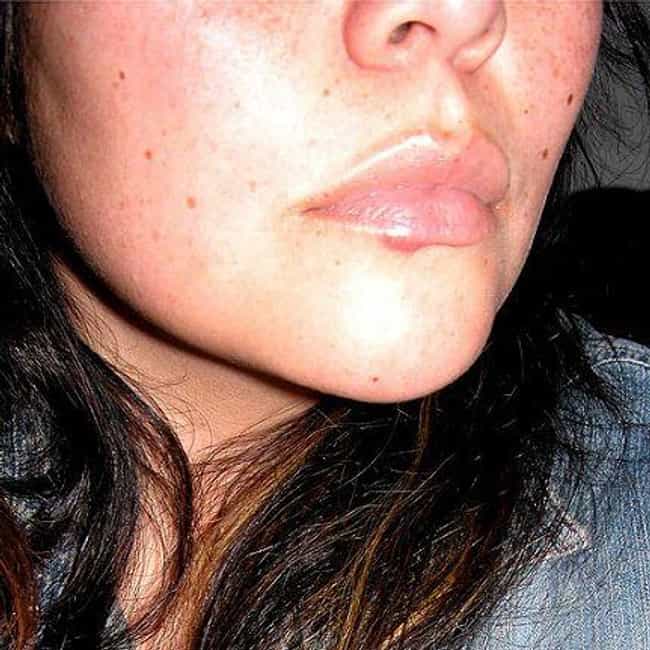 Герпес на щеке фото как выглядит Герпес на щеке фото как выглядит