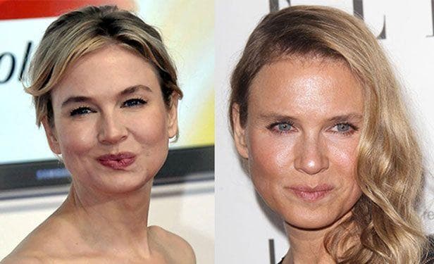 Рене зеллвегер фото сейчас после пластики Renée Zellweger, Before and After Bad celebrity plastic surgery, Plastic surgery