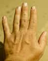 Hairless Hands on Random Most Common Recessive Genes In Humans