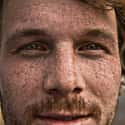 Non-Freckled Skin on Random Most Common Recessive Genes In Humans