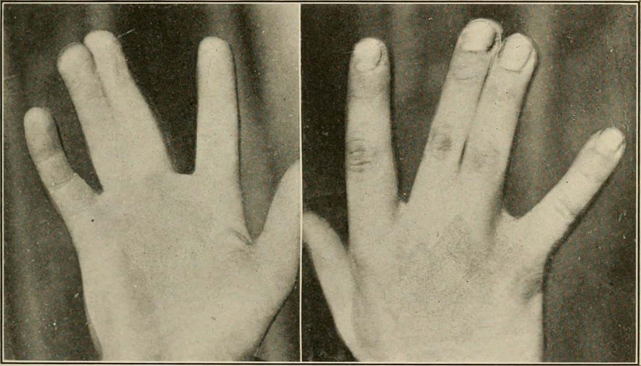 Non-Fused Fingers