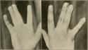 Non-Fused Fingers on Random Most Common Recessive Genes In Humans