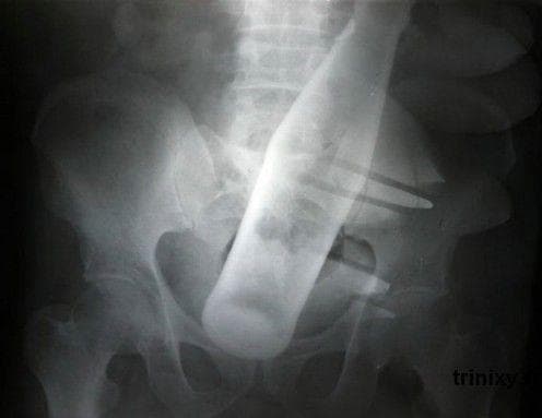 25 Brutal XRay Pictures That Will Make Your Bones Hurt