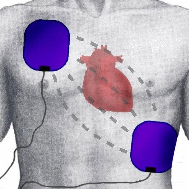 What Happens to Your Body When a Defibrillator Is Used on You