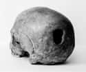 They Drilled Holes In Skulls To Improve General Health on Random Horrifying Medical Procedures Doctors Actually Practiced In 19th Century