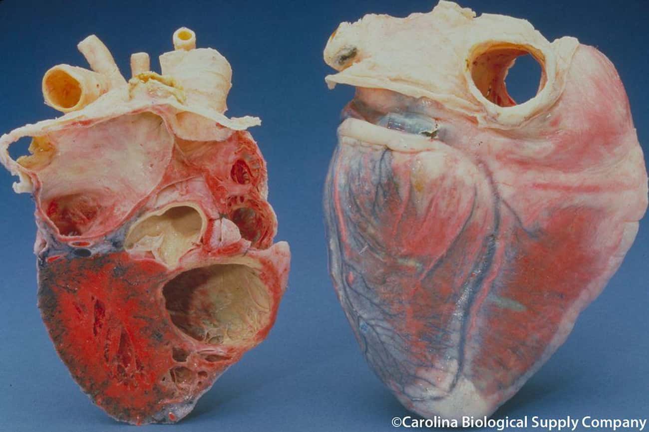 Your Donor Heart Will Likely Come From Someone Who's Brain Dead