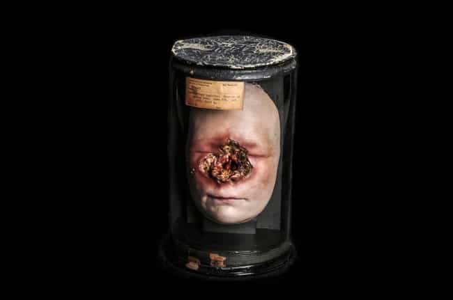 Syphilis Face Wax Figure is listed (or ranked) 4 on the list 14 Super Weird And Disgusting Things On Display At The Mütter Museum