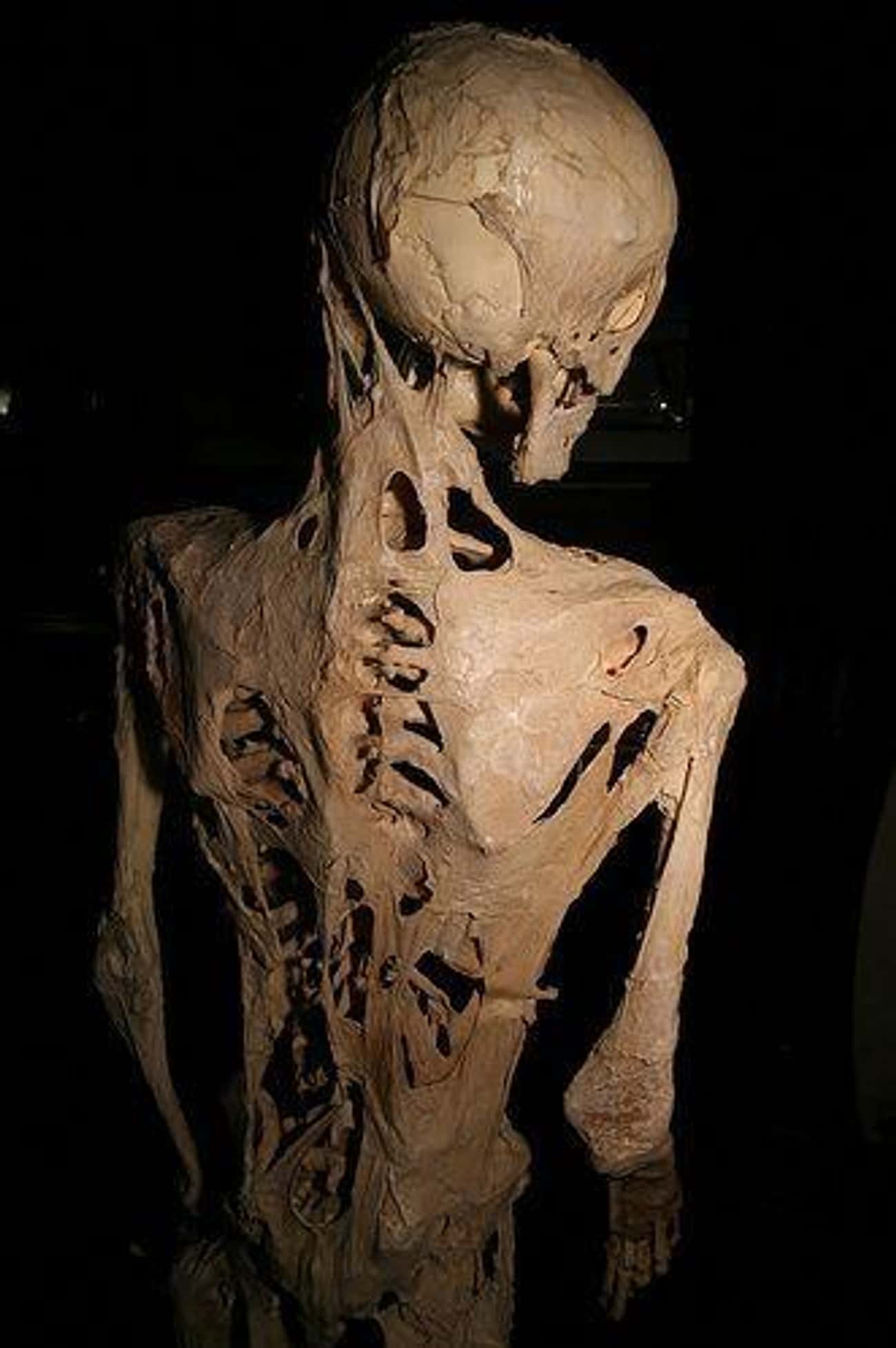Henry Raymond Eastlack&#39;s Calcified Skeleton