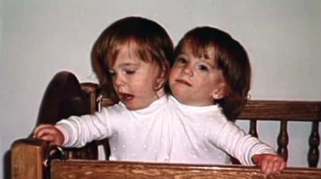 abby and brittany hensel third arm