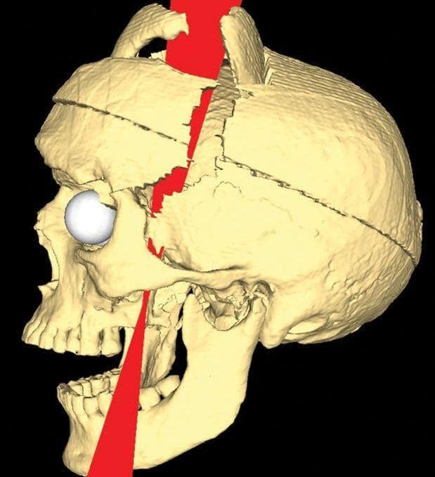 Horrifying Facts About Phineas Gage The Man Who Impaled His Brain