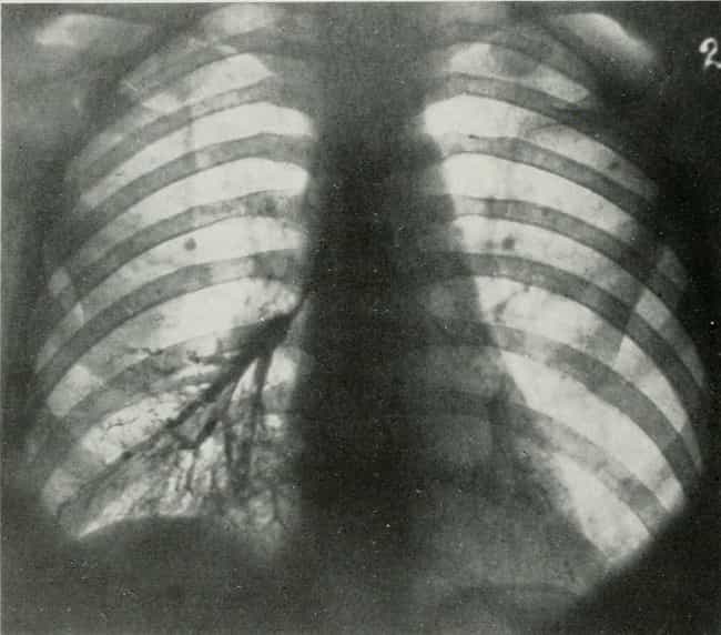 examples of radium poisoning