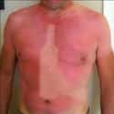 Oh, Stop Wining About Your Sunburn on Random Epic and Painful Sunburns