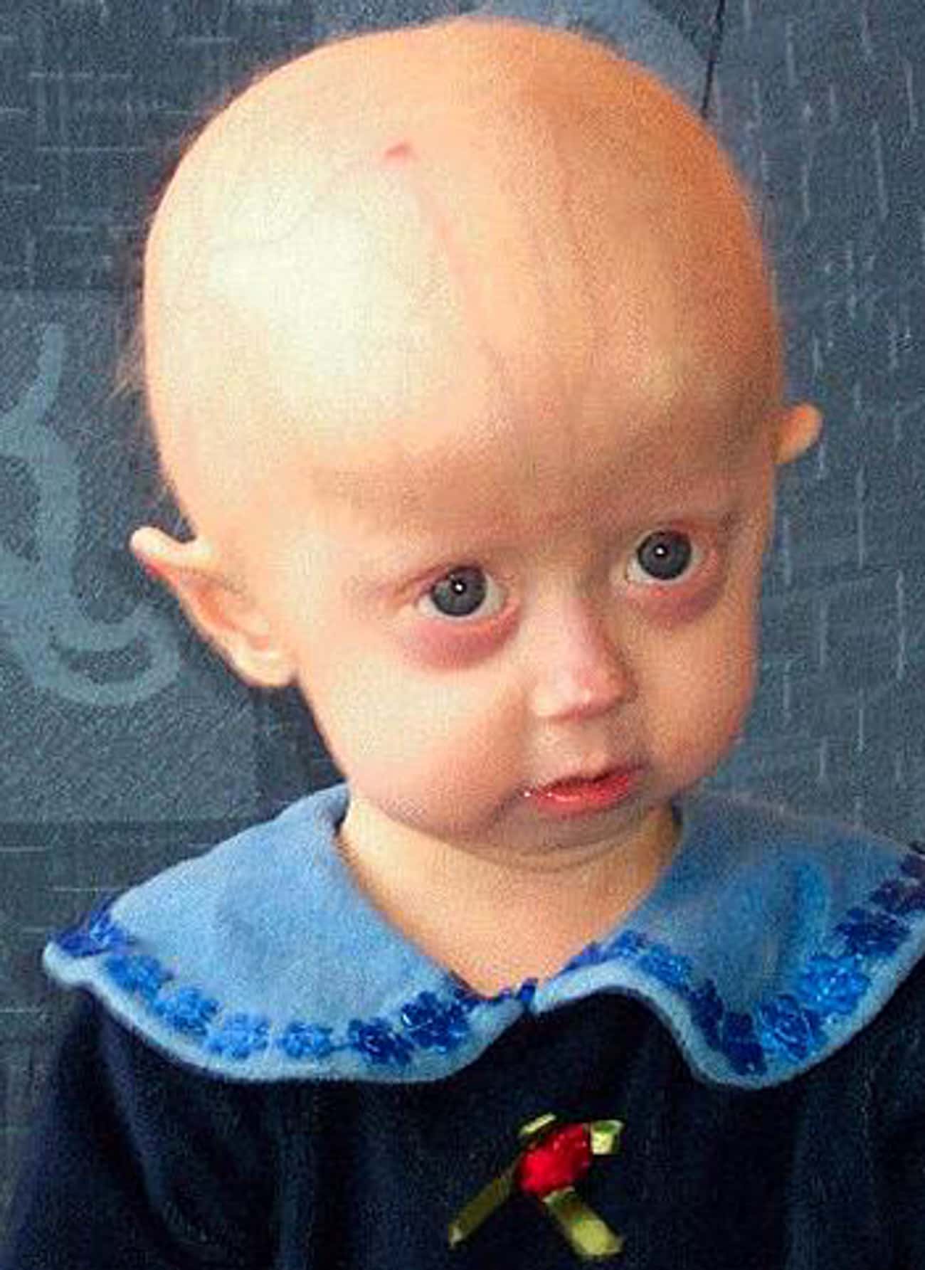 People With Progeria Can Have Children, But It&#39;s Extremely Rare