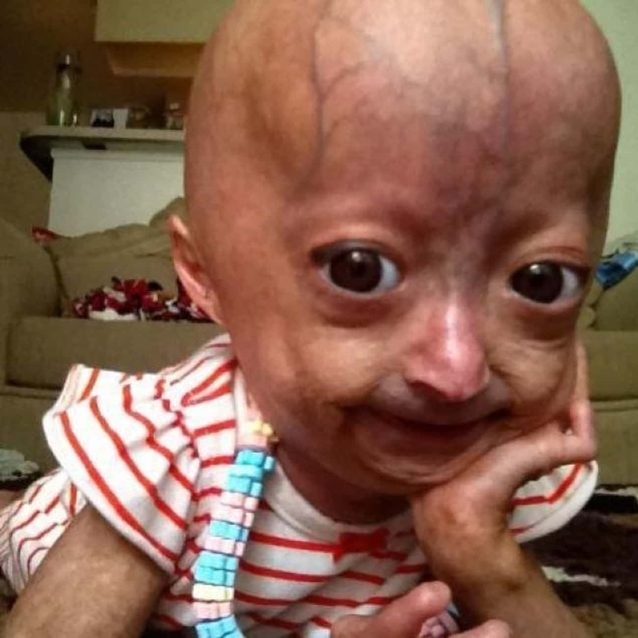 Life Expectancy For Progeria Patients Is Low