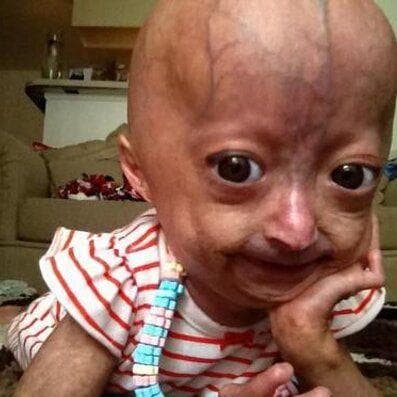 15 Fascinating Facts About Progeria, The Rapid Aging Disease