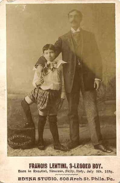 The Strange Life Of Frank Lentini, "The ThreeLegged Wonder"