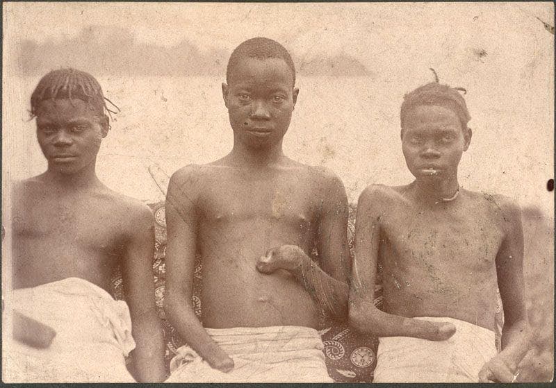 Hands Like The Severed One In The Photograph Were Used As A Morbid Currency In The Congo