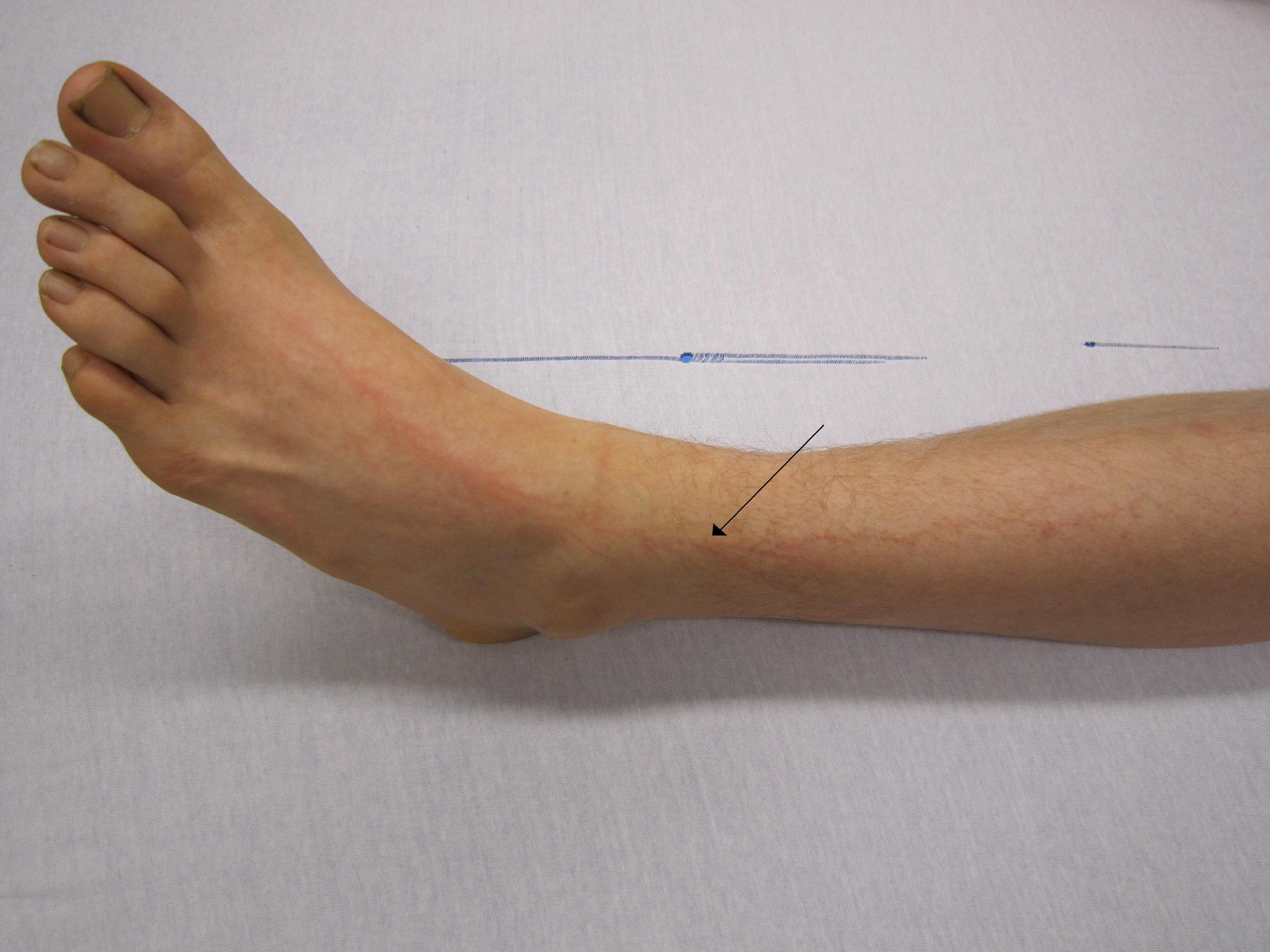 Pictures Of What Happens After You Get Hit By Lightning