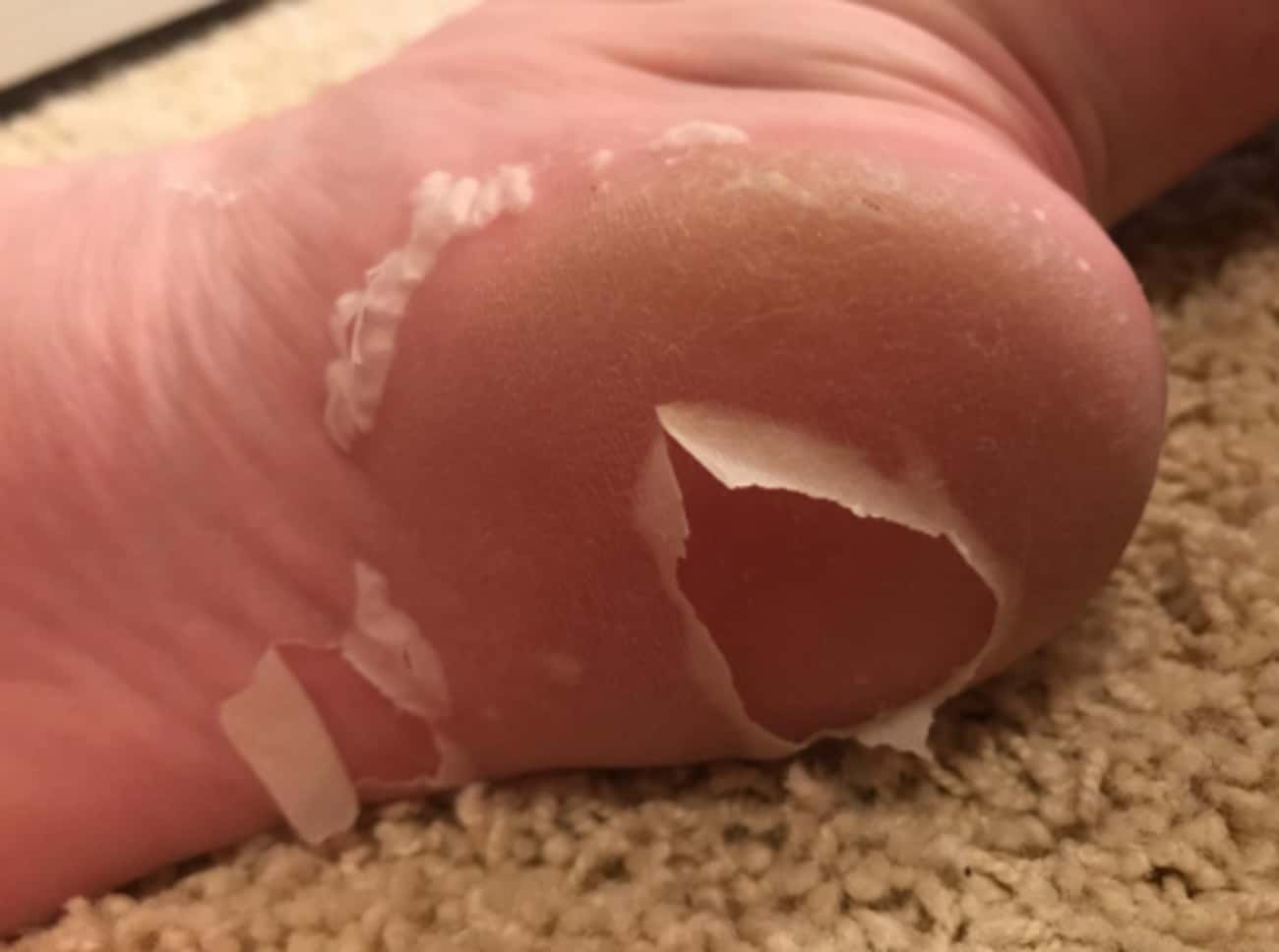 This Skin Peel Promises Baby Soft Feet