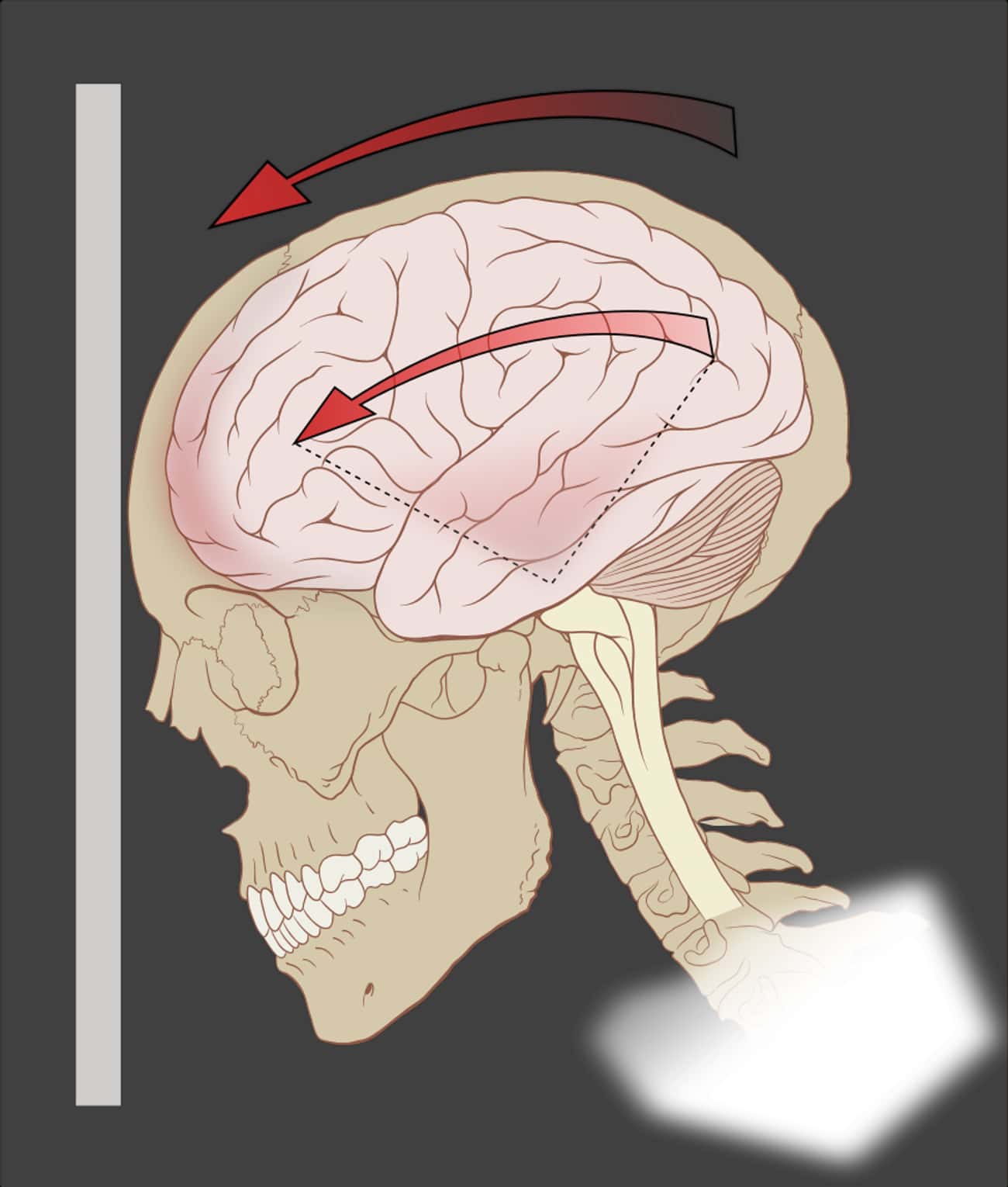 Сотрясение тканей. Сотрясение головы и головного мозга.