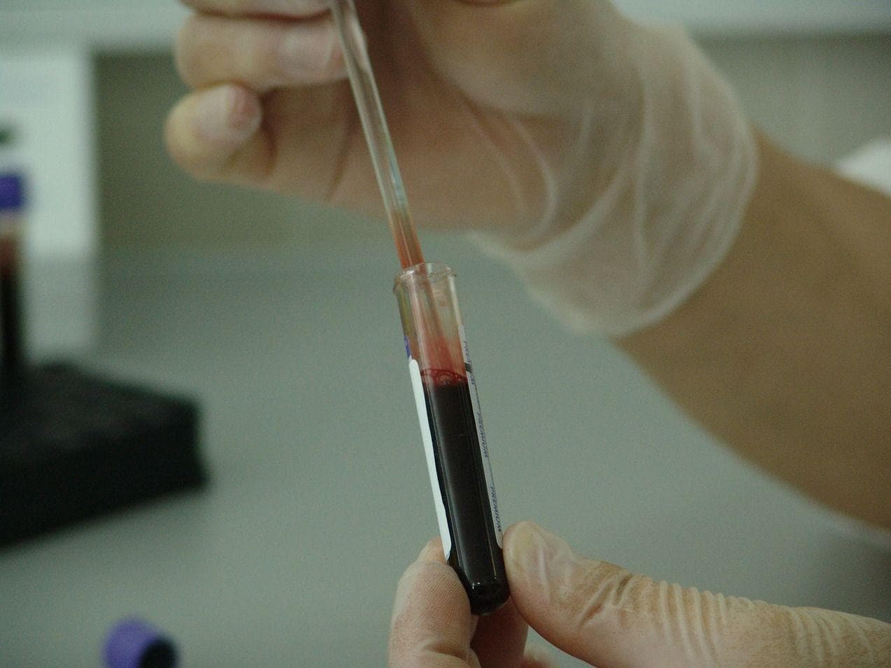  People With Type O Blood Are Less Likely To Develop Heart Disease