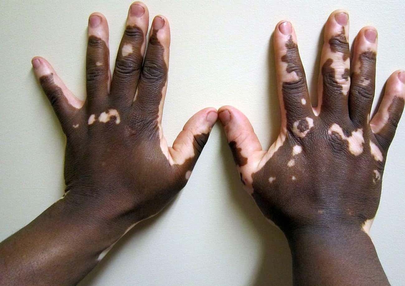 Vitiligo May Be An Autoimmune Disease