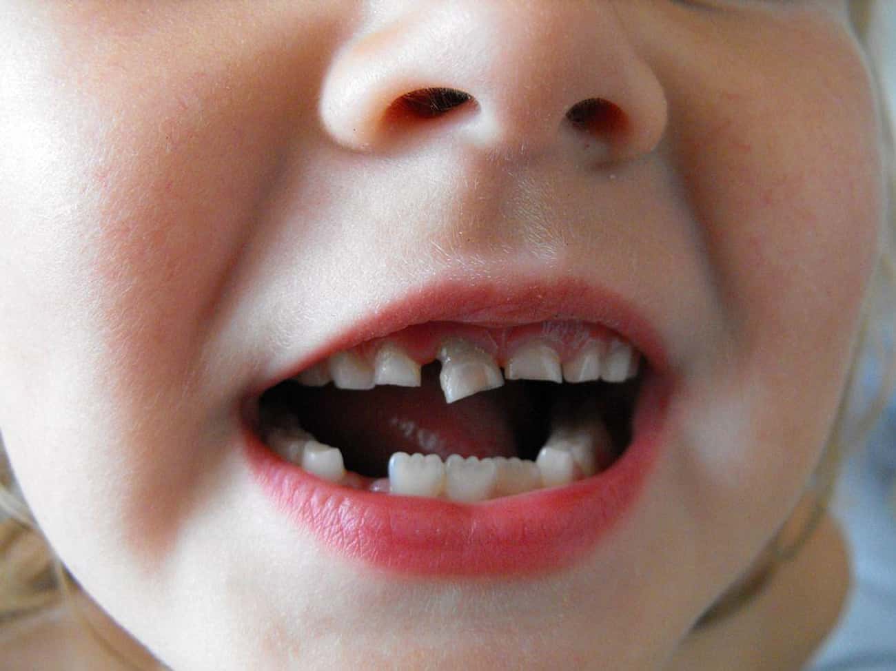 Dreams About Teeth Falling Out Suggest Change