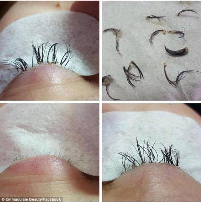 Ресницы после наращивания. Демодекозный блефарит. Нарощенные ресницы отпавшие. Неудачно нарощенные ресницы. Что делать если выпадают нарощенные ресницы.