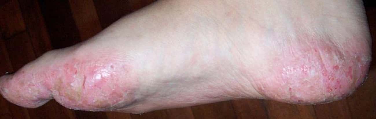 Dyshidrotic Eczema Causes Nasty Foot Blisters