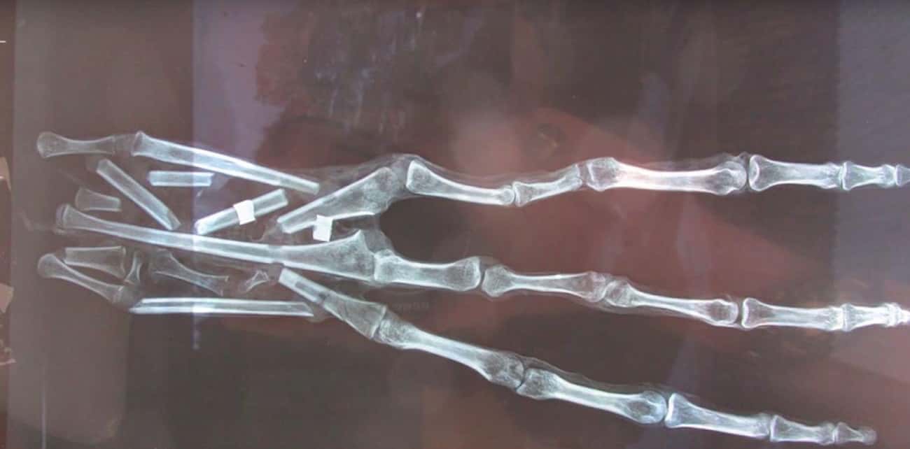 The Medical Examination Revealed Skin And Bone