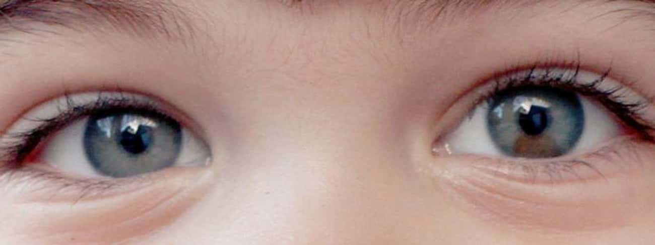 There Are Three Different Types Of Heterochromia