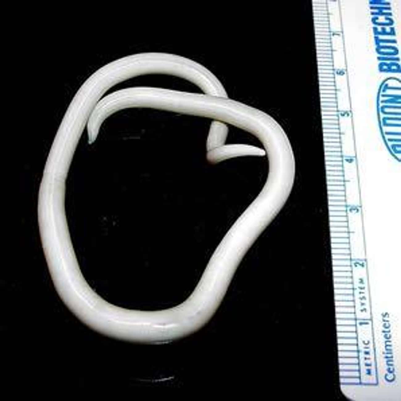 There Are Ways To Tell If You Have A Roundworm Infection