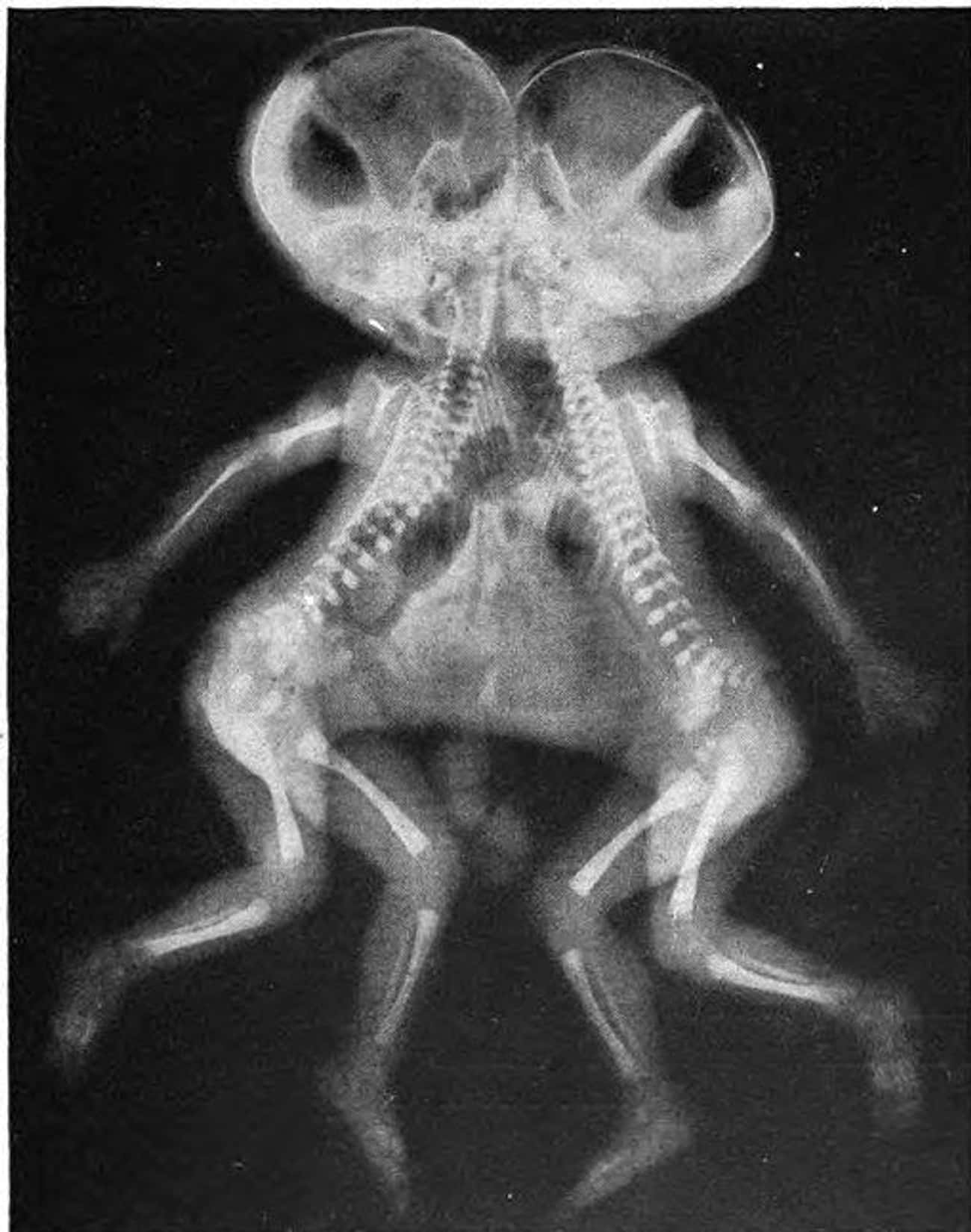 Conjoined Twins Are Rare And Generally Stillborn