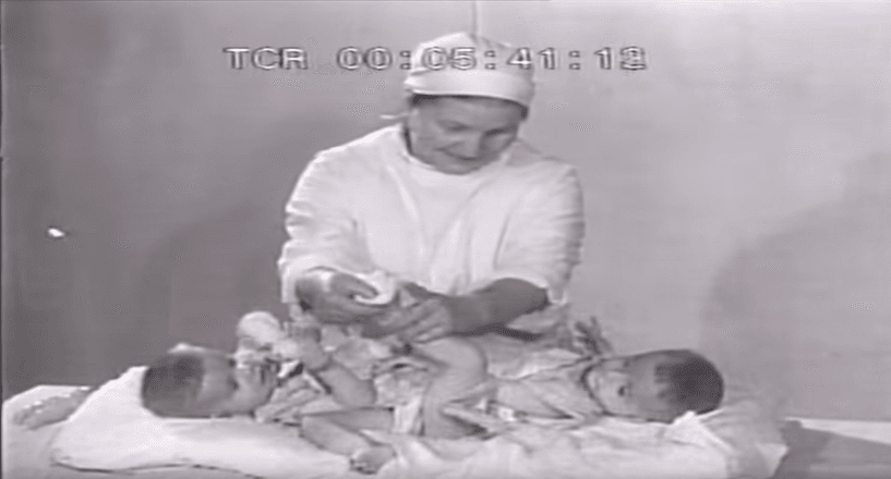 One Was A Psychopath, And One Was An Empath, But These Conjoined Twins