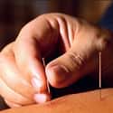 On-Site Acupuncture on Random Best Company Perks