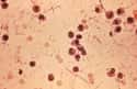 Drug-Resistant Shigella on Random Most Dangerous Drug-Resistant Diseases