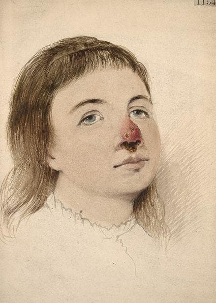 skin infection syphilis Illustration of syphilis: Cliniq. Flickr