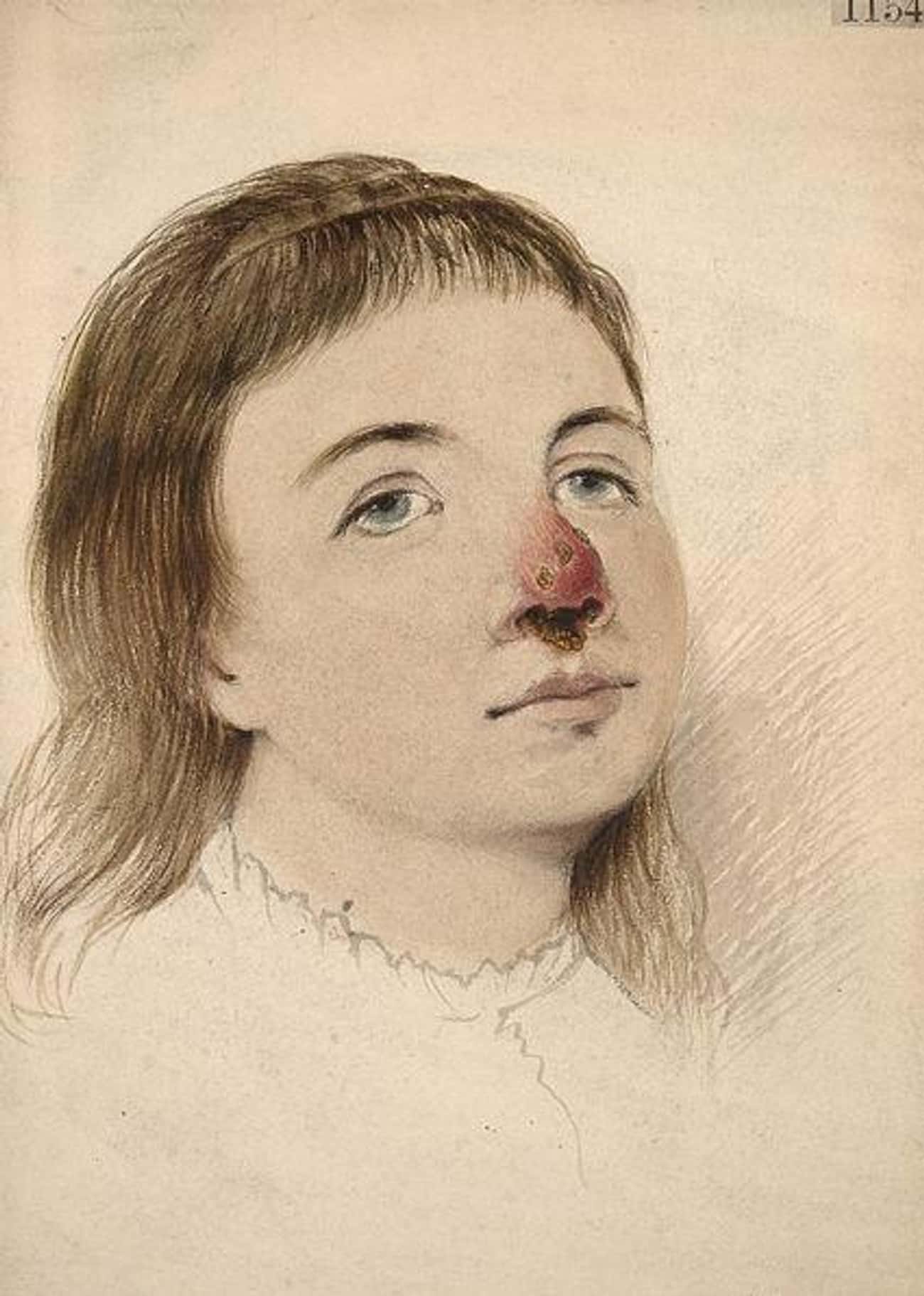 Как выглядит человек болеющий сифилисом Как выглядит человек болеющий сифилисом