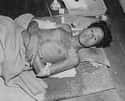 An Atomic Casualty From Nagasaki, Japan (1945) on Random Fascinating Historical Photos We Wish We Learned About In School